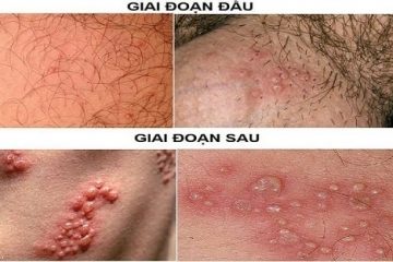 MỤN RỘP SINH DỤC, NGUYÊN NHÂN VÀ CÁCH HỖ TRỢ ĐIỀU TRỊ CHO NAM VÀ NỮ