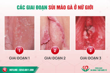 SÙI MÀO GÀ Ở NỮ VÀ CÁCH ĐIỀU TRỊ HẾT BỆNH SÙI MÀO GÀ Ở NỮ