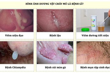 DƯƠNG VẬT CHẢY MỦ LÀ BỆNH GÌ? CÓ NGUY HIỂM KHÔNG?